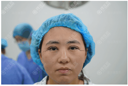 孙欣主任双眼皮修复术后即刻效果图 孙欣主任双眼皮修复术后即刻效果图