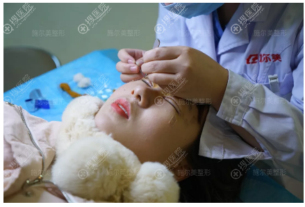 双眼皮修复术后7天来施尔美拆线 双眼皮修复术后7天来施尔美拆线