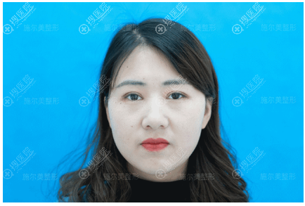 双眼皮修复术后30天恢复效果图 双眼皮修复术后30天恢复效果图