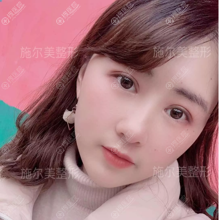 南京施尔美孙欣做的双眼皮失败修复案例 南京施尔美孙欣做的双眼皮失败修复案例