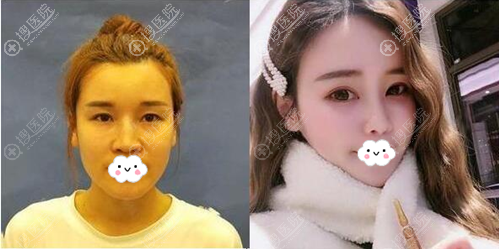 宁波壹加壹郭光烨双眼皮隆鼻术后对比效果 宁波壹加壹郭光烨双眼皮隆鼻术后对比效果