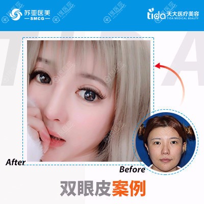 <!--<i data=20240710 data-id=12201></i>-->熊俊文做的双眼皮案例 <!--<i data=20240710 data-id=12201></i>-->熊俊文做的双眼皮案例
