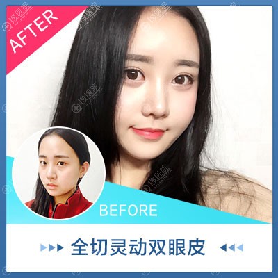 上海愉悦美联臣陈红梅双眼皮案例 上海愉悦美联臣陈红梅双眼皮案例