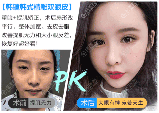 <!--<i data=20240710 data-id=13098></i>-->赵越院长双眼皮案例 <!--<i data=20240710 data-id=13098></i>-->赵越院长双眼皮案例
