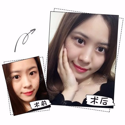 上海时光郑志玉做的双眼皮眼综合案例 上海时光郑志玉做的双眼皮眼综合案例