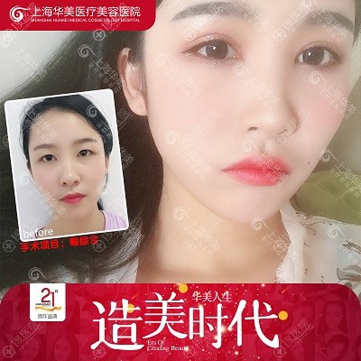 上海华美<!--<i data=20240710 data-id=16301></i>-->park双眼皮案例 上海华美<!--<i data=20240710 data-id=16301></i>-->park双眼皮案例