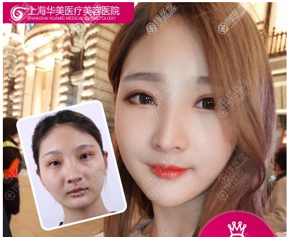 上海华美<!--<i data=20240710 data-id=16294></i>-->做的双眼皮失败修复案例 上海华美<!--<i data=20240710 data-id=16294></i>-->做的双眼皮失败修复案例