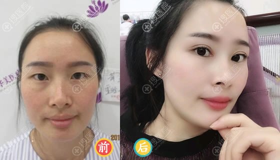 <!--<i data=20240710 data-id=11909></i>-->整形刘彪做双眼皮案例 <!--<i data=20240710 data-id=11909></i>-->整形刘彪做双眼皮案例