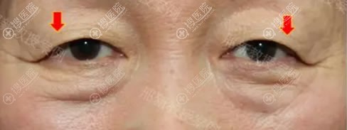 论眼睛上睑眼皮松弛下垂怎么矫正?做眼睑矫正3种手术方法及效果