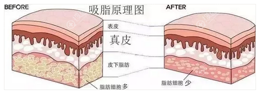 抽脂手术后皮肤会松弛吗?吸脂后皮肤松弛怎么办?