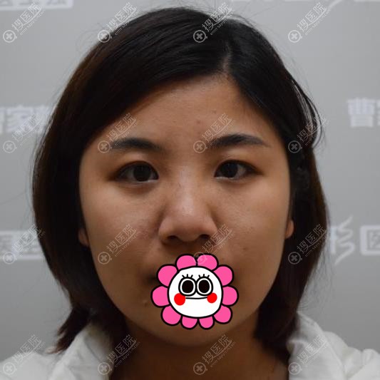 邵阳双眼皮去哪里做好?这是我在邵阳曹家找黄远当做眼综合案例