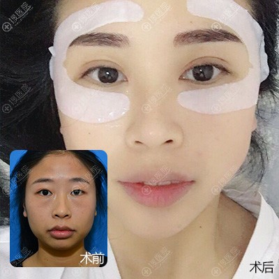 <!--<i data=20240710 data-id=11958></i>-->整形<!--<i data=20240710 data-id=15875></i>-->做的双眼皮案例 <!--<i data=20240710 data-id=11958></i>-->整形<!--<i data=20240710 data-id=15875></i>-->做的双眼皮案例