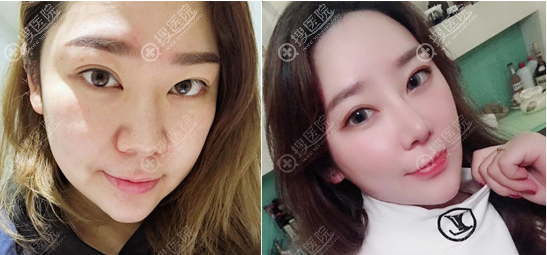 云南华美美莱<!--<i data=20240710 data-id=16786></i>-->鼻综合隆鼻子案例 云南华美美莱<!--<i data=20240710 data-id=16786></i>-->鼻综合隆鼻子案例