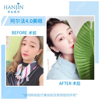 昆明韩辰胡乔做的双眼皮眼综合案例 昆明韩辰胡乔做的双眼皮眼综合案例