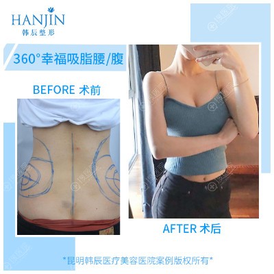昆明韩辰陈宁院长做的360°幸福吸脂案例 昆明韩辰陈宁院长做的360°幸福吸脂案例