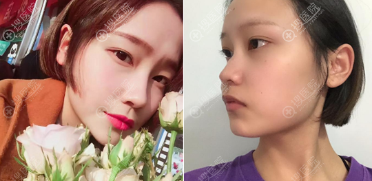 昆明吴氏嘉美<!--<i data=20240710 data-id=16760></i>-->鼻综合隆鼻手术案例 昆明吴氏嘉美<!--<i data=20240710 data-id=16760></i>-->鼻综合隆鼻手术案例