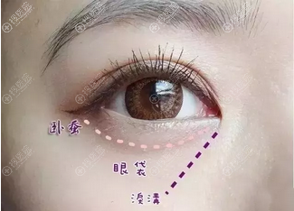 卧蚕、眼袋、泪沟的区别 卧蚕、眼袋、泪沟的区别