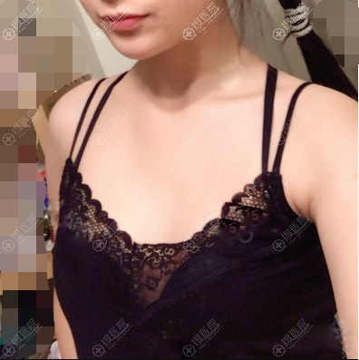 找深圳福华胡俊杰做了假体隆胸手术以后,同事试了手感也想丰胸