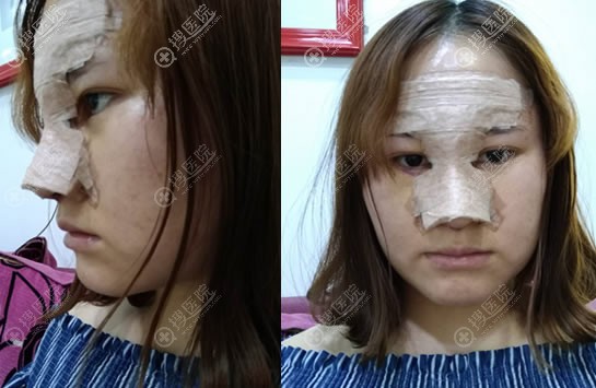贵州利美康隆鼻案例即刻效果 贵州利美康隆鼻案例即刻效果