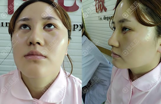 贵州整形口腔美容外科医院隆鼻案例 贵州整形口腔美容外科医院隆鼻案例