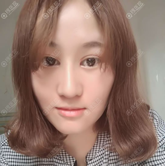 <!--<i data=20240710 data-id=15860></i>-->整形双眼皮隆鼻案例 <!--<i data=20240710 data-id=15860></i>-->整形双眼皮隆鼻案例