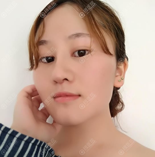 贵州利美康外科医院隆鼻案例 贵州利美康外科医院隆鼻案例