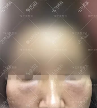20岁就有泪沟的我注射玻尿酸填充失败后选择自体脂肪填充成功了