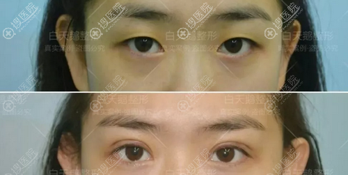 为了坚持空姐梦想,她在江油白天鹅找余强做了双眼皮和大腿吸脂