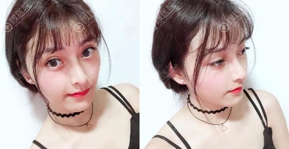 遵义利美康唐芳明隆鼻案例 遵义利美康唐芳明隆鼻案例