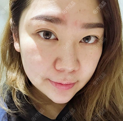 花7万元去昆明华美美莱找韩国做鼻子很有名的黄在弘做了鼻综合