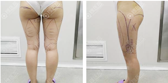西安抽脂哪家好?看我花两万多元在西安高一生做的大腿吸脂效果