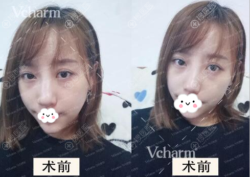 在重庆鹏爱找黄震亚做了鼻综合手术后,我甩掉了“匹诺曹”外号