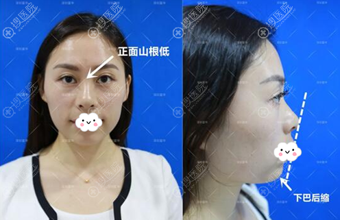 深圳富华李秀林3支玻尿酸隆鼻丰下巴改变脸部轮廓附术后对比图
