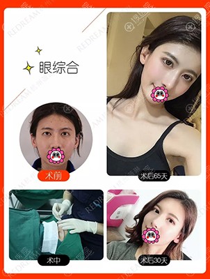 杭州薇琳眼综合案例效果 杭州薇琳眼综合案例效果