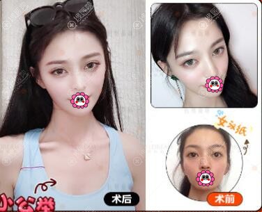杭州薇琳自体脂肪面部填充效果 杭州薇琳自体脂肪面部填充效果