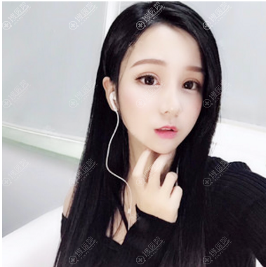 张林宏双眼皮修复和隆鼻手术案例 张林宏双眼皮修复和隆鼻手术案例