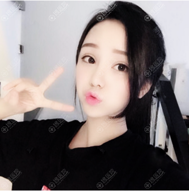 西安高一生张林宏医生双眼皮修复案例 西安高一生张林宏医生双眼皮修复案例