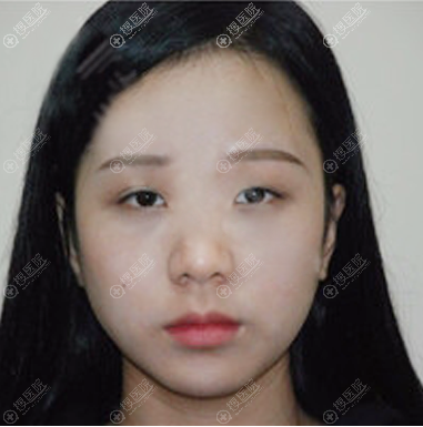 看了西安高一生张林宏的案例后决定找他为我做双眼皮修复和隆鼻