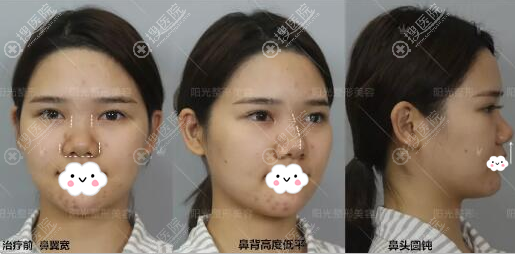 深圳阳光整形韩国医生朴在久做的膨体鼻综合术后效果超级适合我