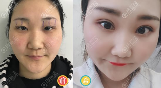 <!--<i data=20240710 data-id=11903></i>-->王晓敏双眼皮案例 <!--<i data=20240710 data-id=11903></i>-->王晓敏双眼皮案例
