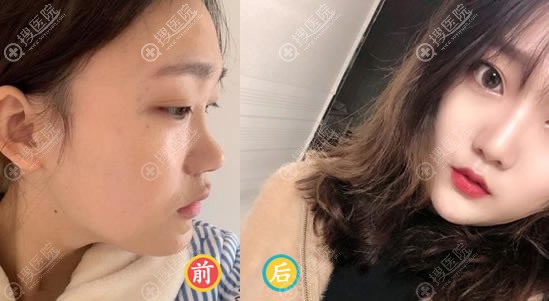 <!--<i data=20240710 data-id=11903></i>-->整形赵玉超隆鼻案例 <!--<i data=20240710 data-id=11903></i>-->整形赵玉超隆鼻案例