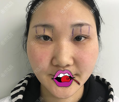 4月初花7千多价格在宜昌楚美人做了全切双眼皮和开眼角眼综合