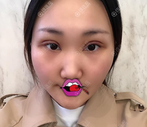 <!--<i data=20240710 data-id=11903></i>-->王晓敏做双眼皮案例 <!--<i data=20240710 data-id=11903></i>-->王晓敏做双眼皮案例