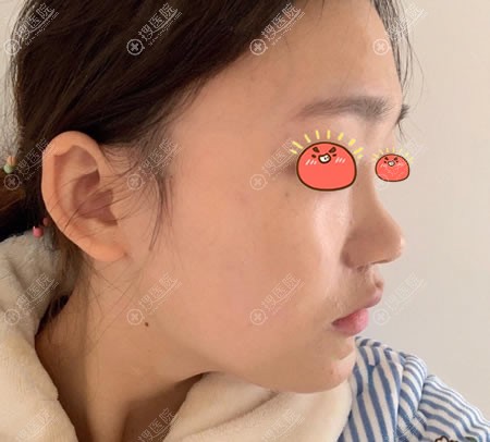 打宜昌楚美人整形电话预约赵玉超医生做了韩式海鸥鼻综合隆鼻
