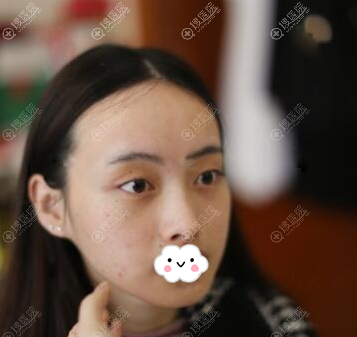 找深圳阳光整形美容医院汤跃明做全面部脂肪填充后摆脱松垮脸