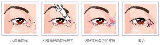 开内眼角手术过程示意图 开内眼角手术过程示意图