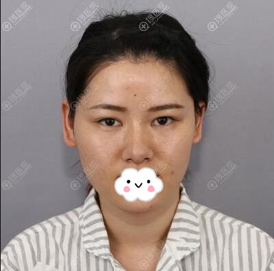 深圳阳光陈瑞红埋线提升半年效果依旧明显,我打算带妈妈去体验