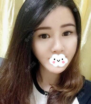陈瑞红埋线提升术后50天恢复效果图 陈瑞红埋线提升术后50天恢复效果图