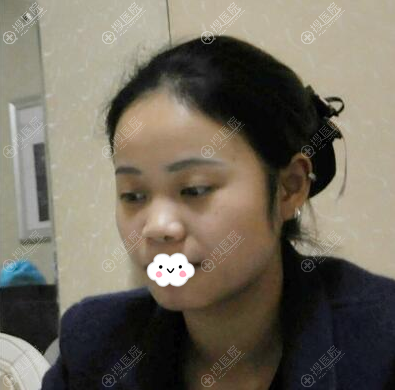 深圳富华整形斯良洪国硅胶假体加耳软骨隆鼻术后一个月恢复照片