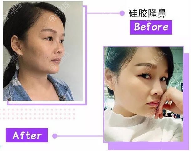 西宁夏都整形周婷隆鼻案例 西宁夏都整形周婷隆鼻案例